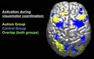 fMRI-derived image of difference between brains of autistic and control groups. Legend reads "Activation during visuomotor coordination: Autism Group [yellow], Control Group [Blue], Overlap (both groups) [green]".